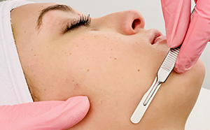 Dermaplaning